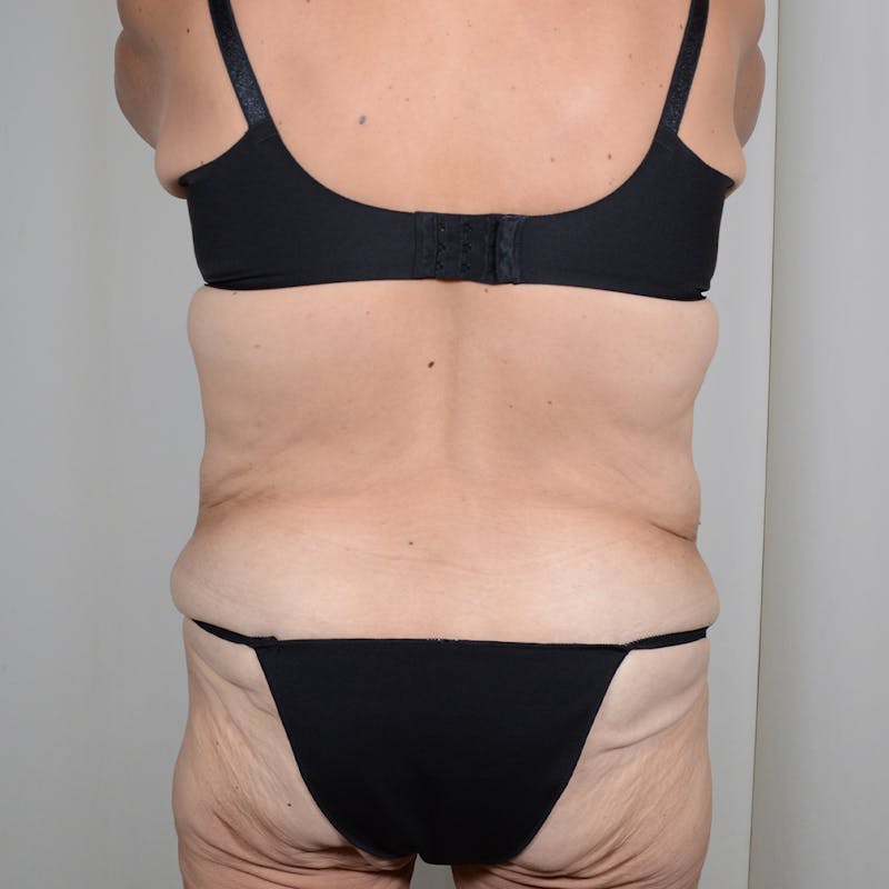 Tummy Tuck Before & After Gallery - Patient 890357 - Image 7
