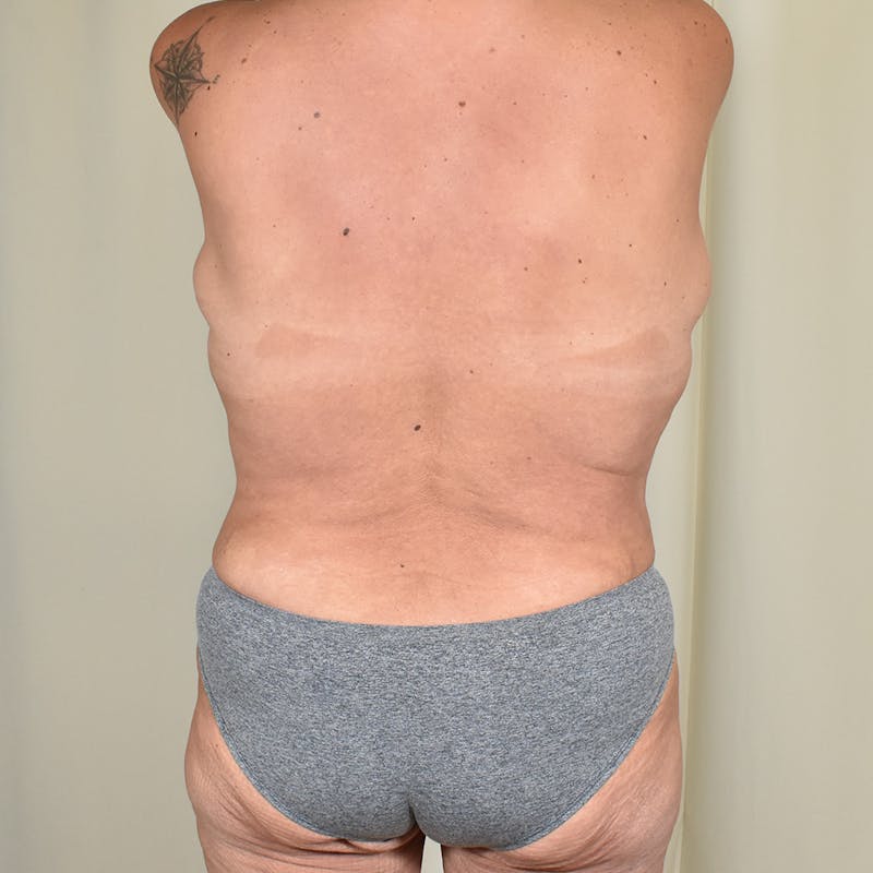 Tummy Tuck Before & After Gallery - Patient 890357 - Image 8
