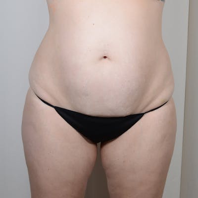 Tummy Tuck Before & After Gallery - Patient 624307 - Image 1