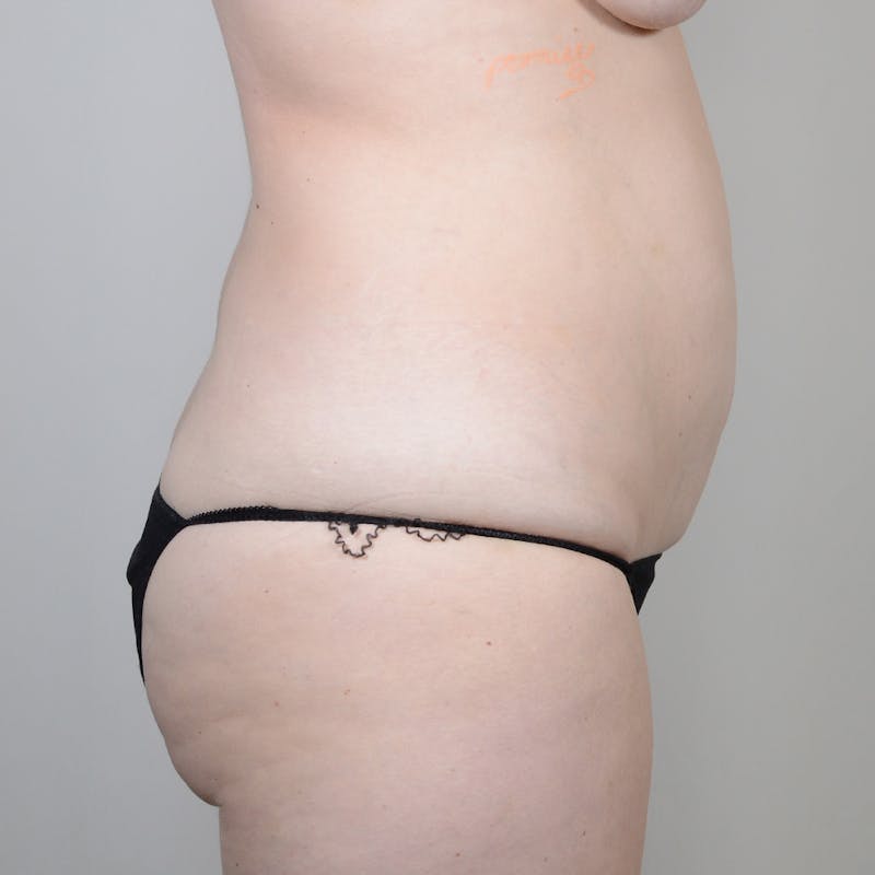 Tummy Tuck Before & After Gallery - Patient 624307 - Image 3