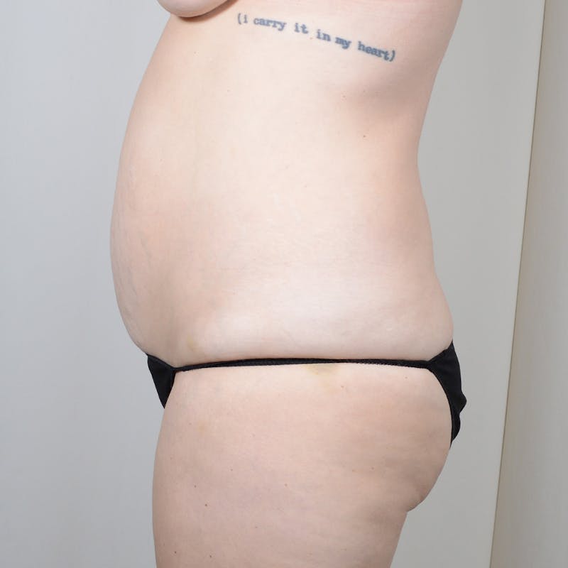 Tummy Tuck Before & After Gallery - Patient 624307 - Image 5