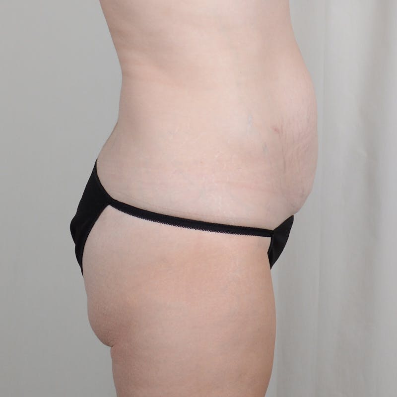 Tummy Tuck Before & After Gallery - Patient 278559 - Image 3