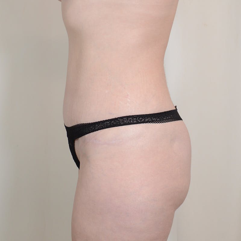 Tummy Tuck Before & After Gallery - Patient 278559 - Image 6
