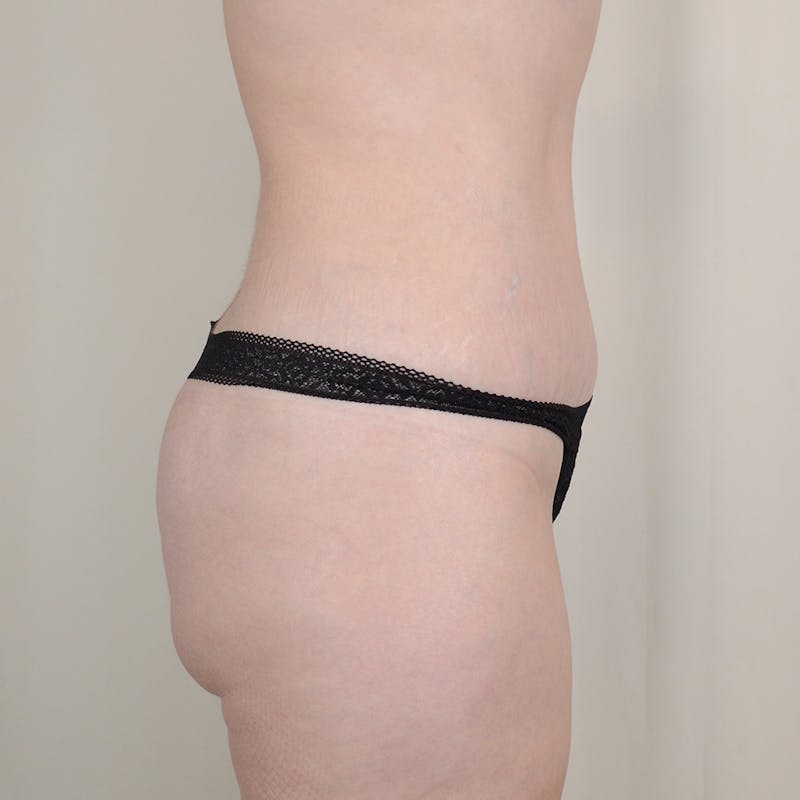 Tummy Tuck Before & After Gallery - Patient 278559 - Image 4