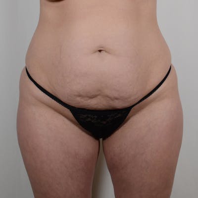 Tummy Tuck Before & After Gallery - Patient 139748 - Image 1