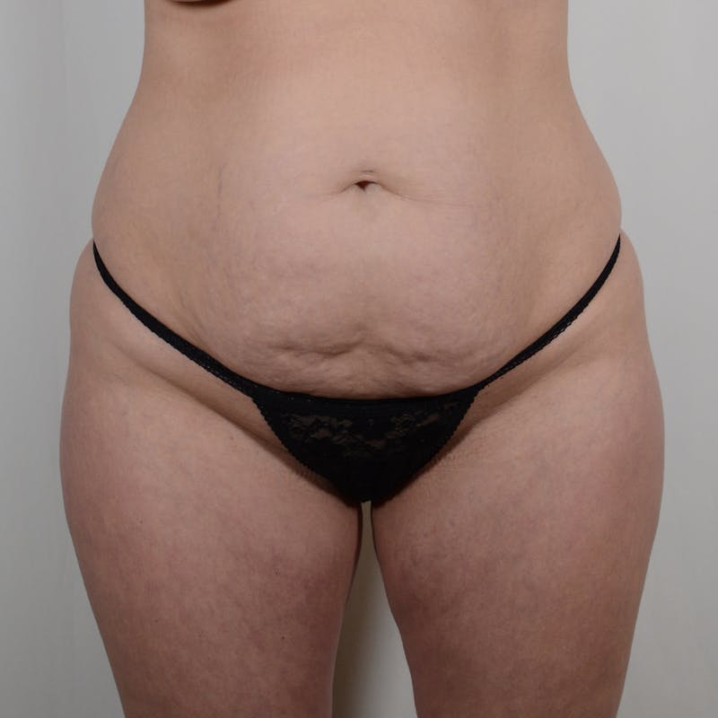 Tummy Tuck Before & After Gallery - Patient 139748 - Image 1