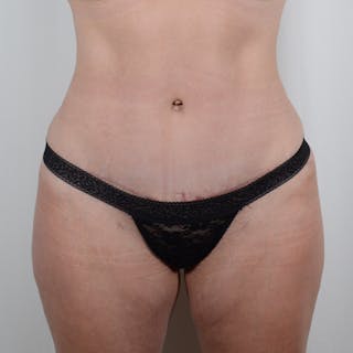 Tummy Tuck Before & After Gallery - Patient 139748 - Image 2