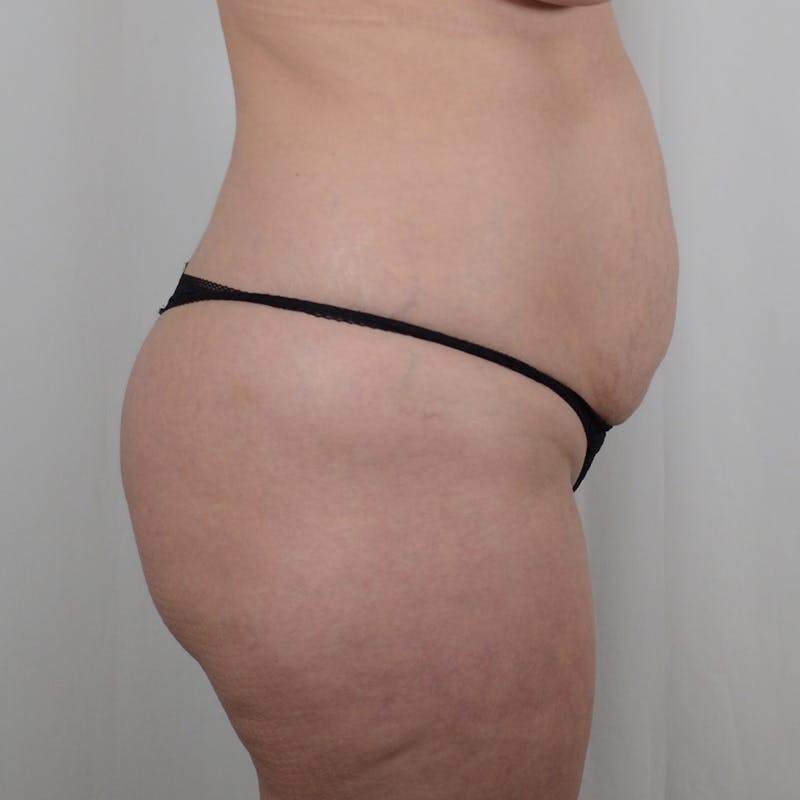 Tummy Tuck Before & After Gallery - Patient 139748 - Image 3