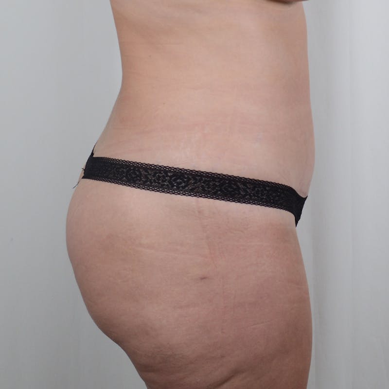 Tummy Tuck Before & After Gallery - Patient 139748 - Image 4