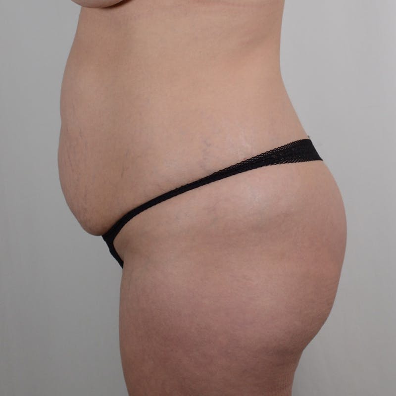 Tummy Tuck Before & After Gallery - Patient 139748 - Image 5