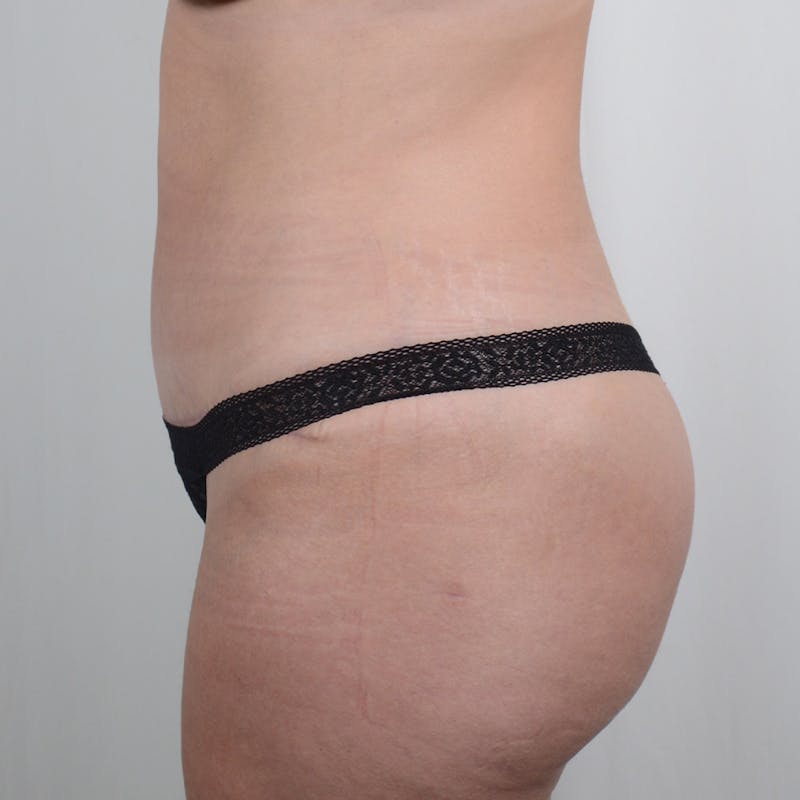 Tummy Tuck Before & After Gallery - Patient 139748 - Image 6