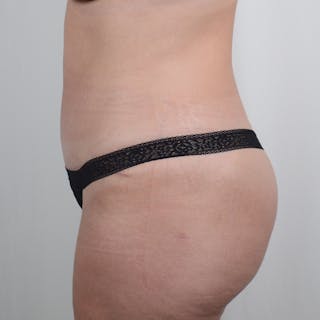 Tummy Tuck Before & After Gallery - Patient 139748 - Image 6