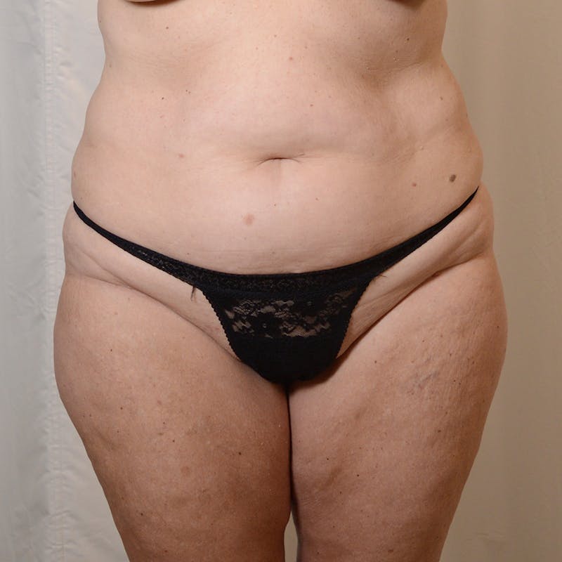 Tummy Tuck Before & After Gallery - Patient 371195 - Image 1