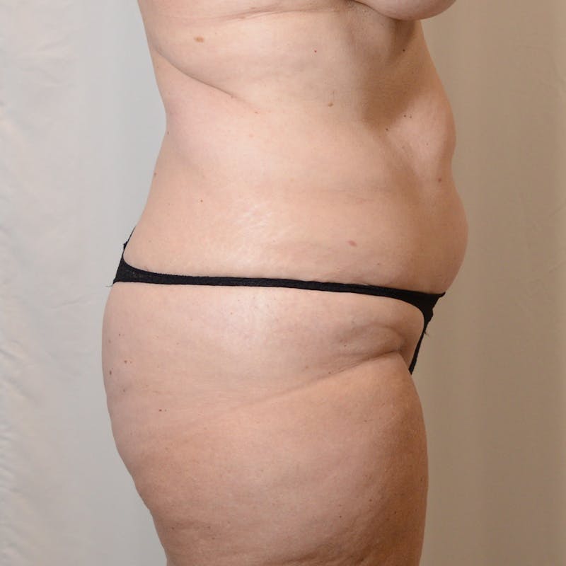 Tummy Tuck Before & After Gallery - Patient 371195 - Image 3