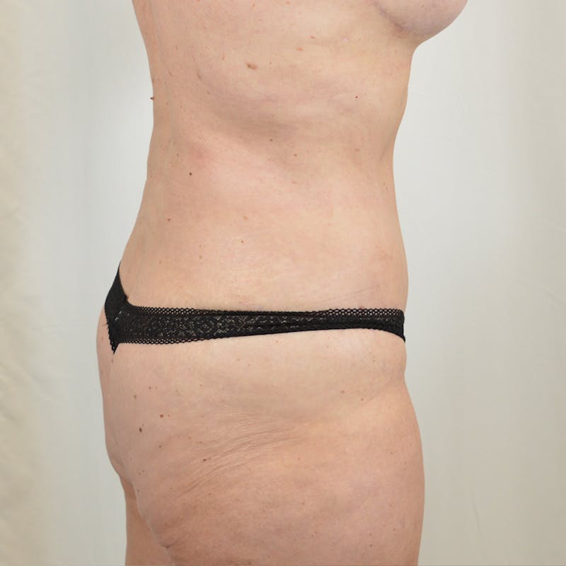 Tummy Tuck Before & After Gallery - Patient 371195 - Image 4