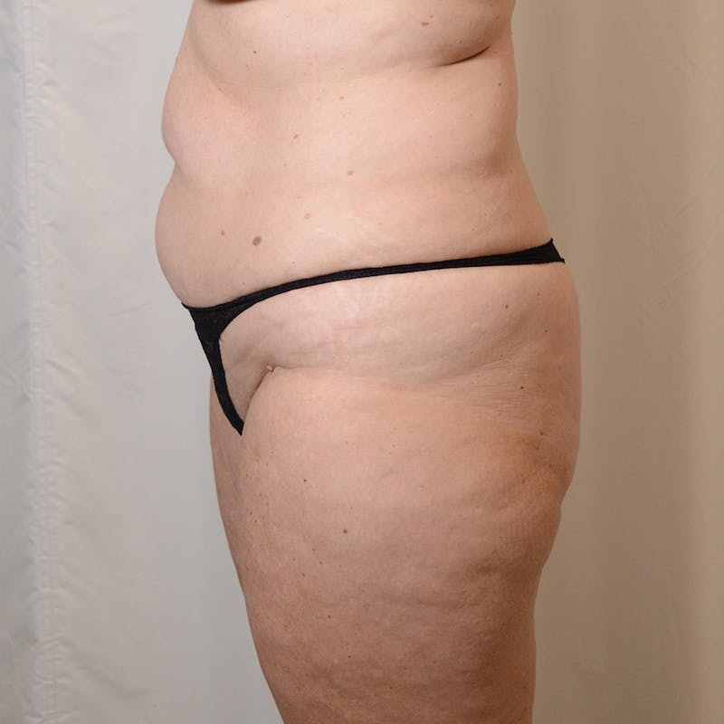 Tummy Tuck Before & After Gallery - Patient 371195 - Image 5