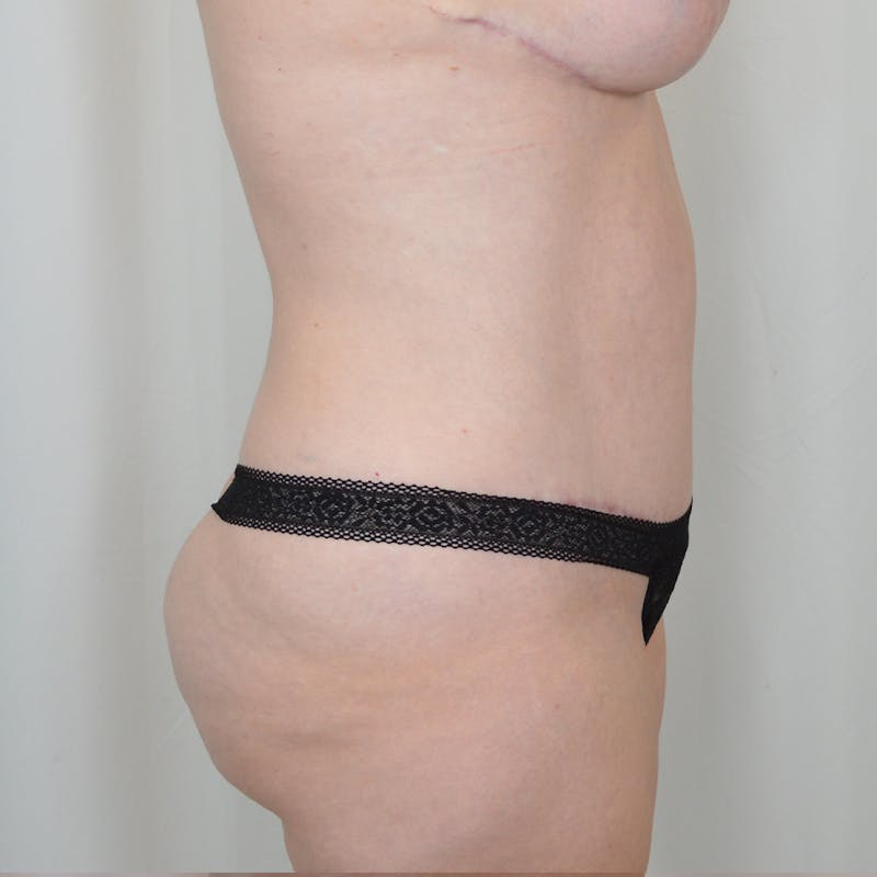Tummy Tuck Before & After Gallery - Patient 291347 - Image 4
