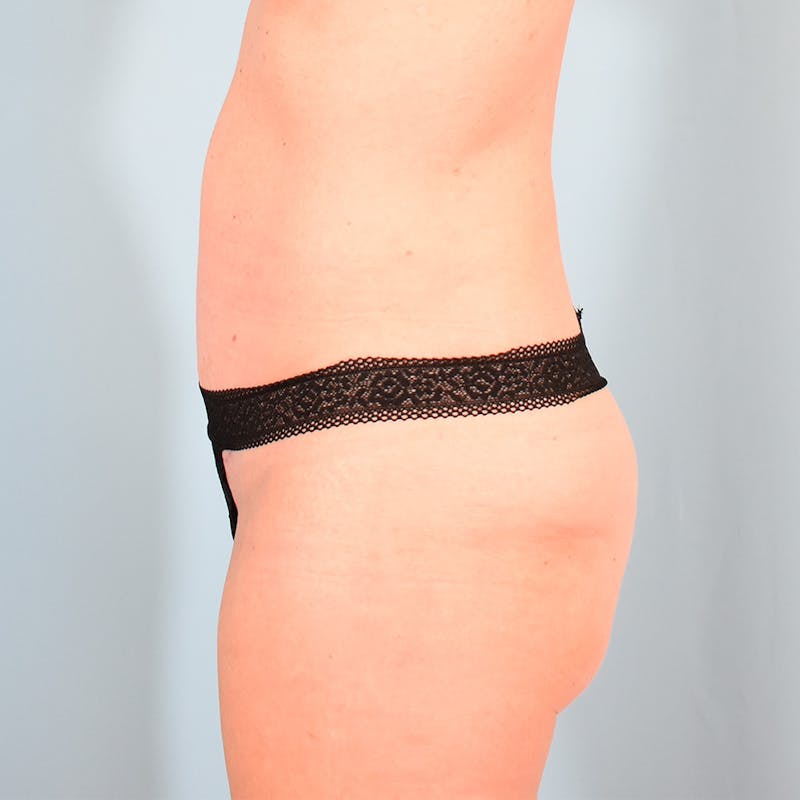 Tummy Tuck Before & After Gallery - Patient 130988 - Image 6