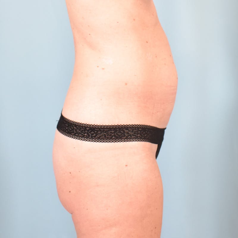 Tummy Tuck Before & After Gallery - Patient 130988 - Image 3