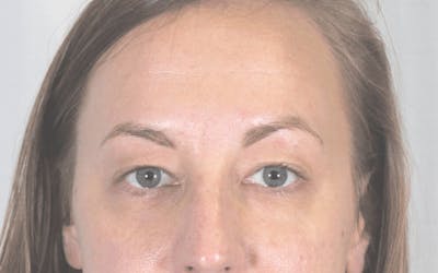 Blepharoplasty Before & After Gallery - Patient 117698 - Image 1