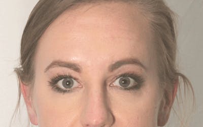 Blepharoplasty Before & After Gallery - Patient 117698 - Image 2