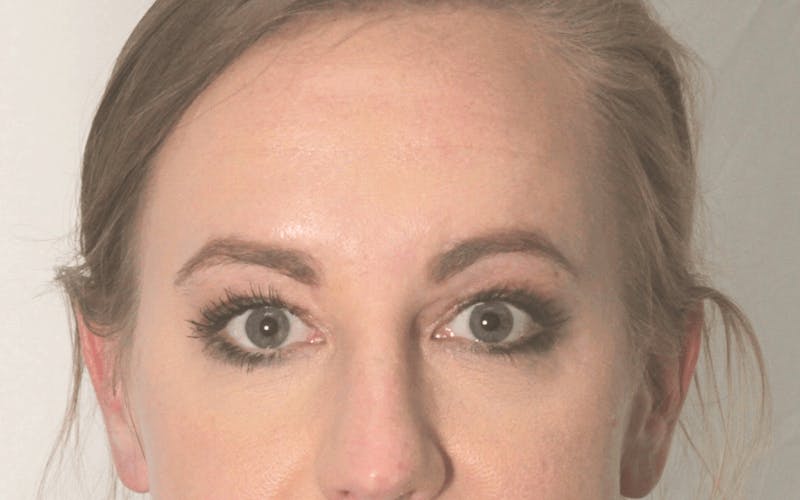 Blepharoplasty Before & After Gallery - Patient 117698 - Image 2