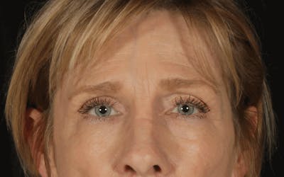 Blepharoplasty Before & After Gallery - Patient 297584 - Image 1