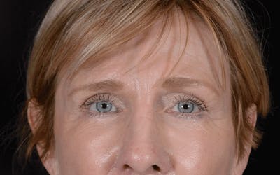 Blepharoplasty Before & After Gallery - Patient 297584 - Image 2