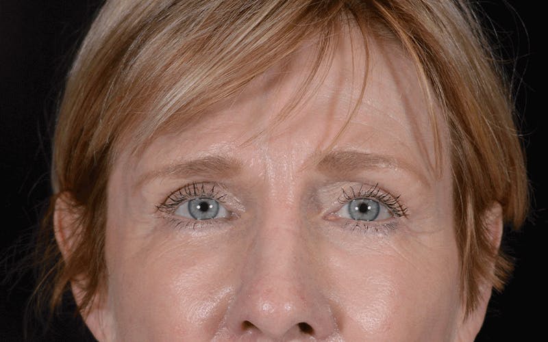 Blepharoplasty Before & After Gallery - Patient 297584 - Image 2