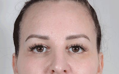 Blepharoplasty Before & After Gallery - Patient 611022 - Image 1