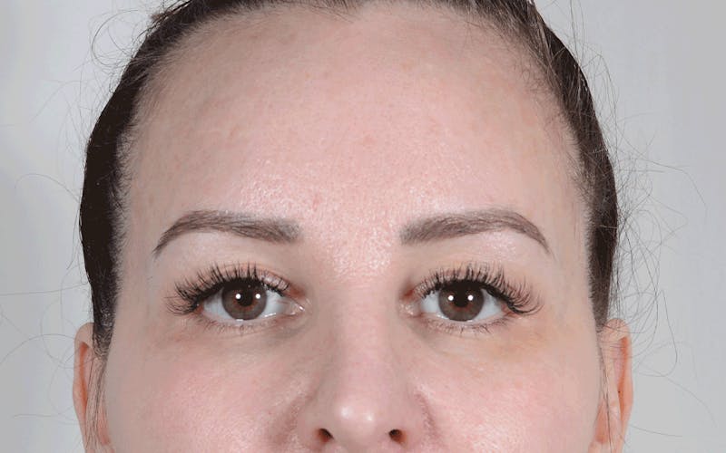 Blepharoplasty Before & After Gallery - Patient 611022 - Image 1