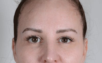 Blepharoplasty Before & After Gallery - Patient 611022 - Image 2
