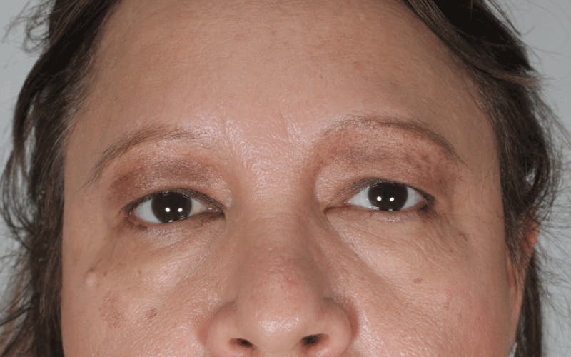 Blepharoplasty Before & After Gallery - Patient 307066 - Image 1
