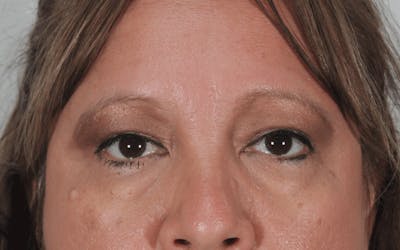 Blepharoplasty Before & After Gallery - Patient 307066 - Image 2