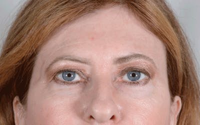 Blepharoplasty Before & After Gallery - Patient 339291 - Image 1