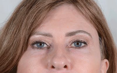 Blepharoplasty Before & After Gallery - Patient 339291 - Image 2
