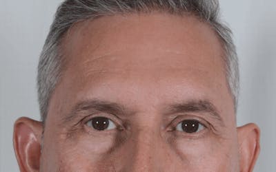 Blepharoplasty Before & After Gallery - Patient 294808 - Image 1