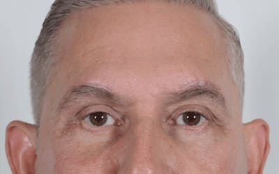 Blepharoplasty Before & After Gallery - Patient 294808 - Image 2