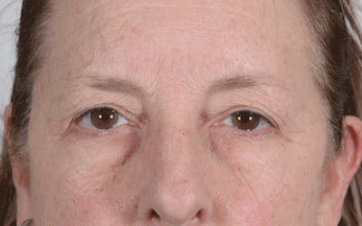 Blepharoplasty Before & After Gallery - Patient 107080 - Image 1