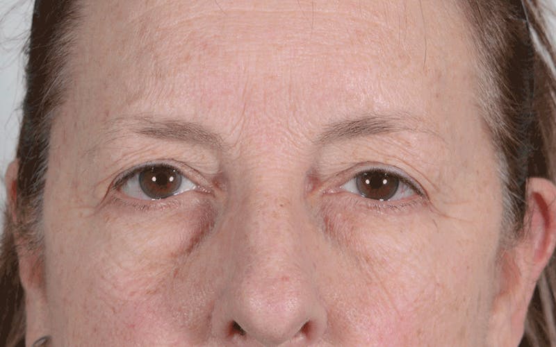Blepharoplasty Before & After Gallery - Patient 107080 - Image 1