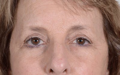Blepharoplasty Before & After Gallery - Patient 107080 - Image 2