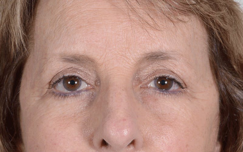 Blepharoplasty Before & After Gallery - Patient 107080 - Image 2
