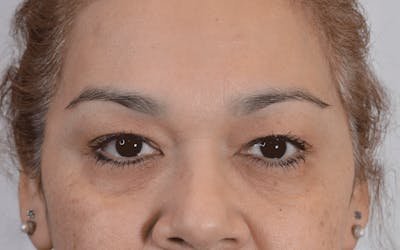 Blepharoplasty Before & After Gallery - Patient 110985 - Image 1