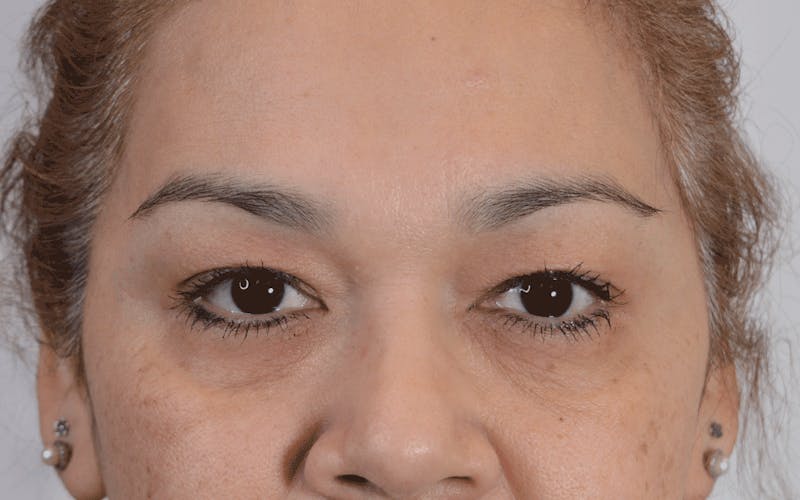 Blepharoplasty Before & After Gallery - Patient 110985 - Image 1