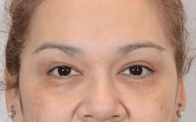 Blepharoplasty Before & After Gallery - Patient 110985 - Image 2