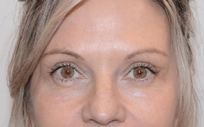Blepharoplasty Before & After Gallery - Patient 412392 - Image 1
