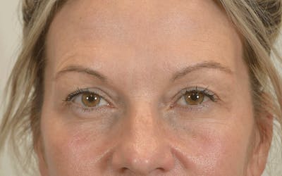 Blepharoplasty Before & After Gallery - Patient 412392 - Image 2