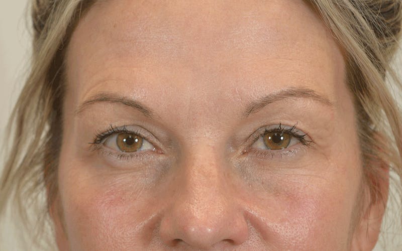 Blepharoplasty Before & After Gallery - Patient 412392 - Image 2