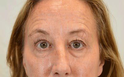 Blepharoplasty Before & After Gallery - Patient 747766 - Image 1
