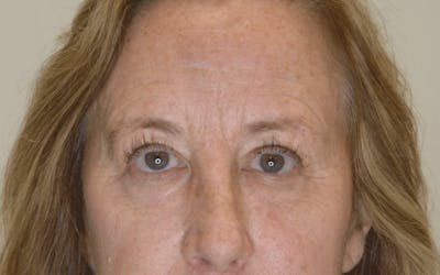 Blepharoplasty Before & After Gallery - Patient 747766 - Image 2